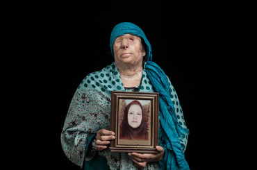 Poruszające portrety ofiar oblanych kwasem - Asghar Khamseh
